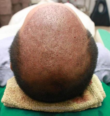 Hair transplantation surgery before and after images