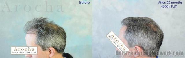 Hair transplantation surgery before and after pictures