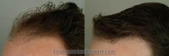 Hair transplantation surgery before and after images