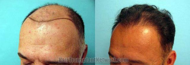 Hair transplantation surgery before and after pictures