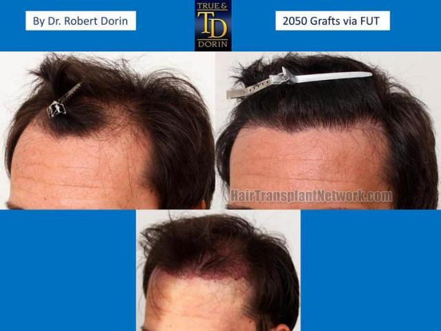 Hair transplantation surgery before and after pictures