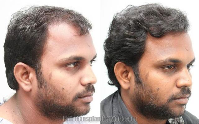 Hair transplantation surgery before and after photos