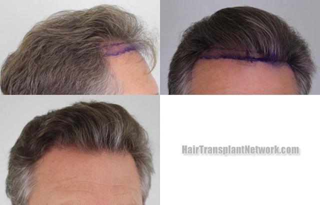 Hair transplantation surgery before and after images