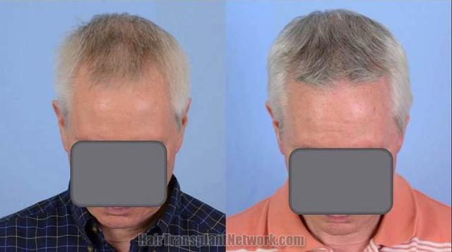 Hair restoration surgery before and after images