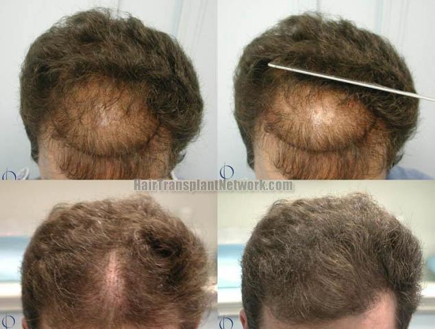 Hair transplant procedure before and after pictures