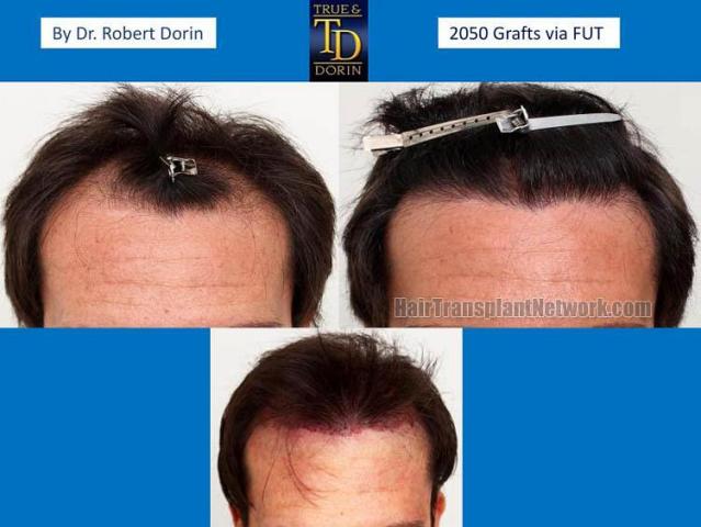 Hair restoration procedure before and after results