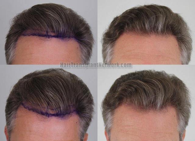 Hair restoration procedure before and after results