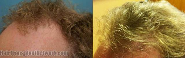 Hair transplantation surgery before and after images