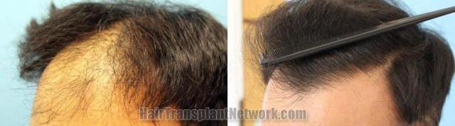 Hair restoration procedure before and after results