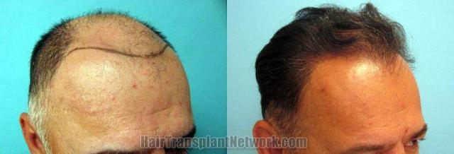 Hair transplantation surgery before and after images