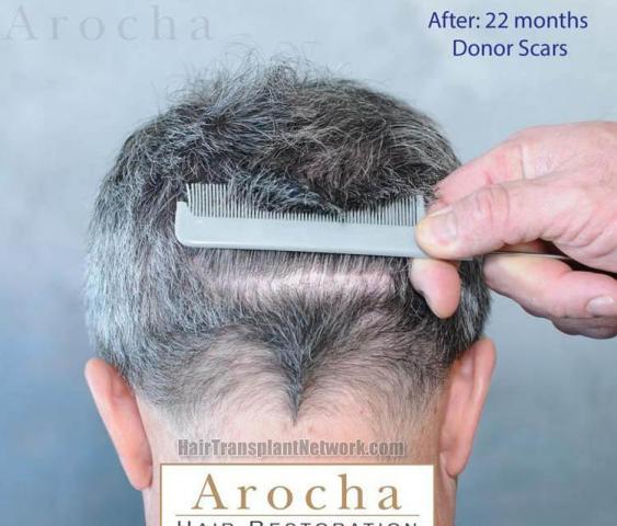 Hair transplantation surgery before and after images