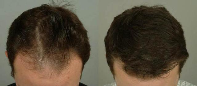 Hair transplantation surgery before and after photos