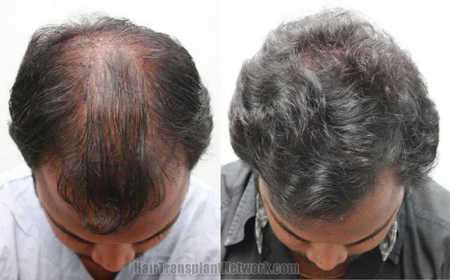 Hair restoration procedure before and after results