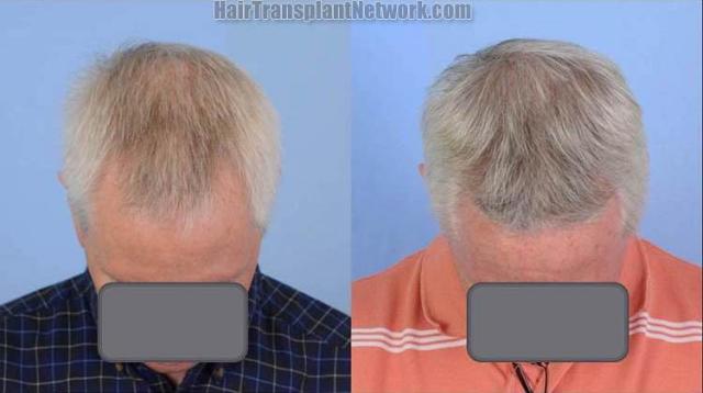 Hair transplantation surgery before and after images