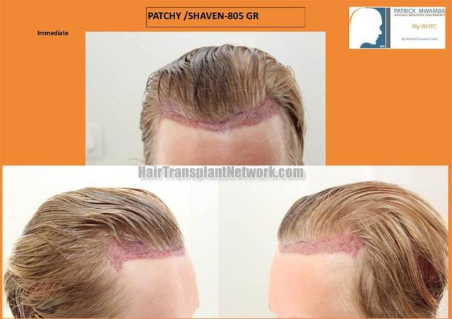 Hair transplant surgery before and after images