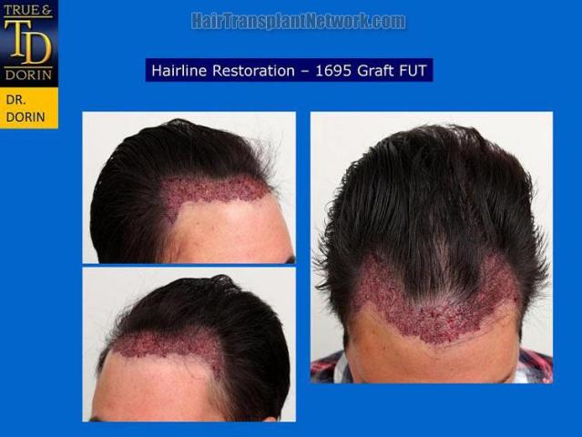 Hair restoration procedure before and after pictures