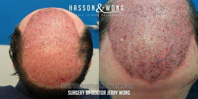 Hair restoration procedure before and after result images