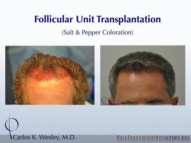 Hair transplant surgery before and after photos