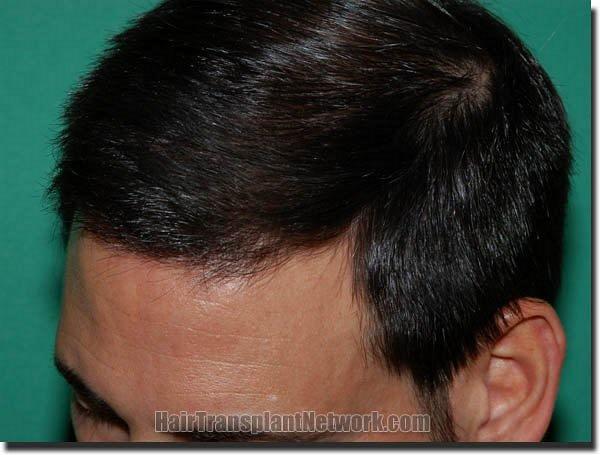 Hair restoration procedure results