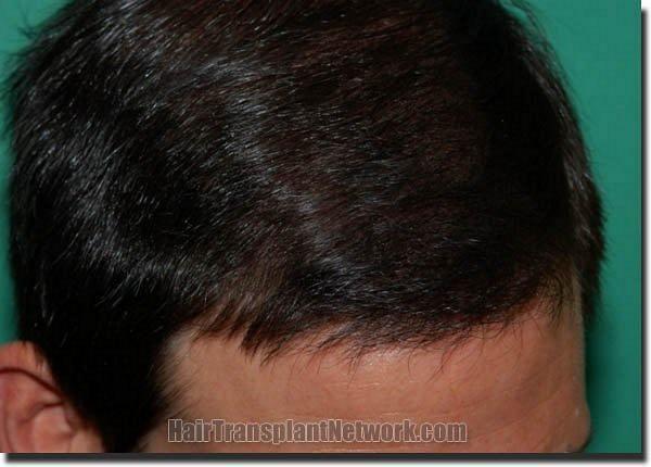 Hair restoration procedure results