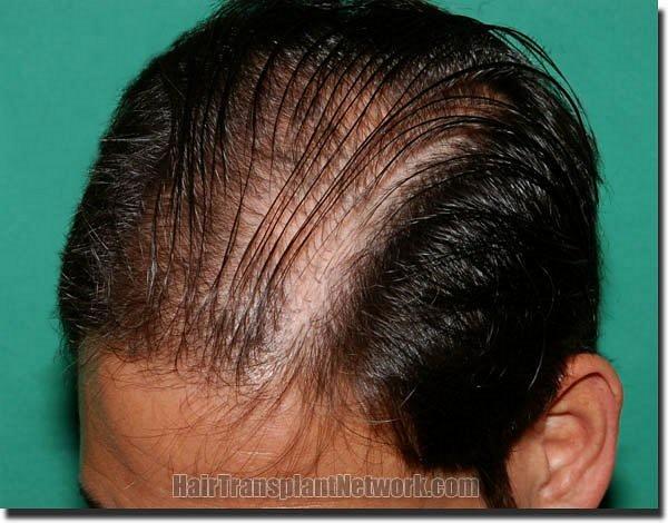 Hair restoration procedure results