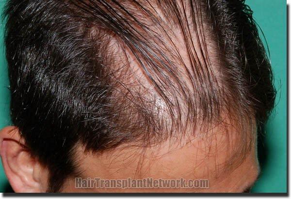 Hair restoration procedure results