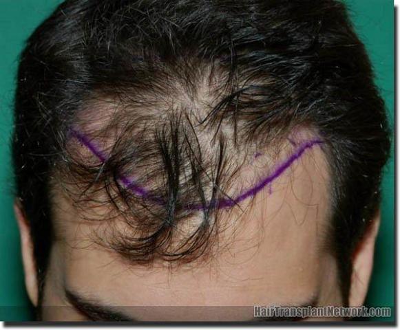 Hair restoration procedure results