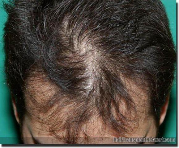 Hair restoration procedure results