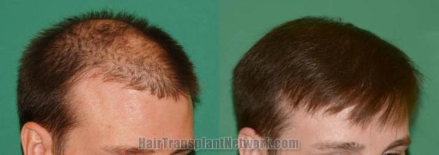 Hair transplantation procedure before and after results