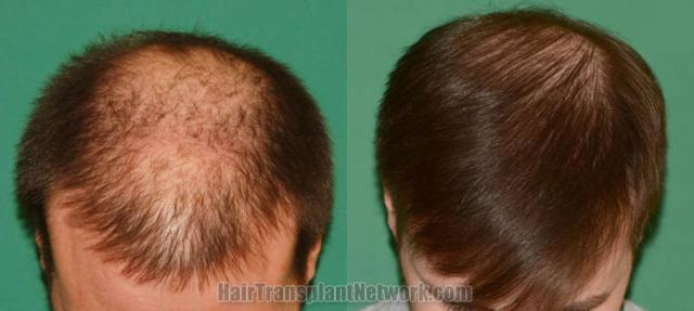 Before and after hair restoration procedure images