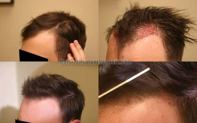 Hair transplantation surgery before and after images