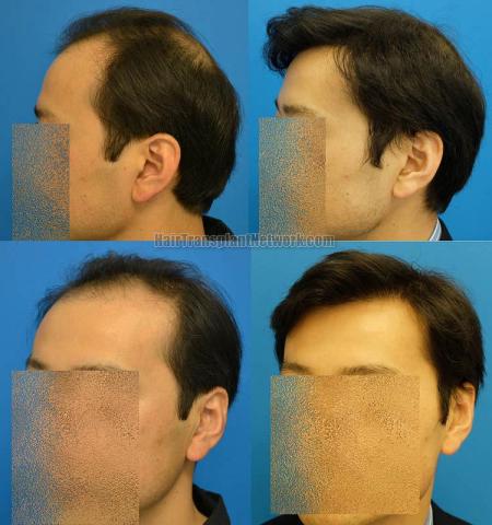 Hair transplantation surgery before and after pictures