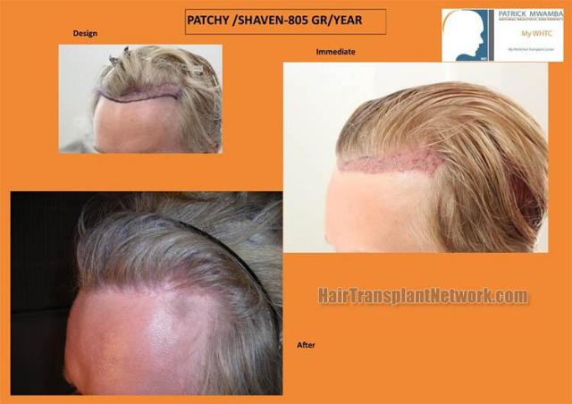 Hair transplantation surgery before and after images