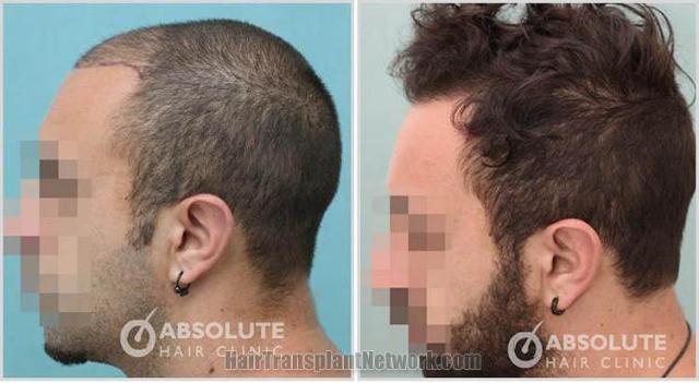 Hair transplantation surgery before and after photos