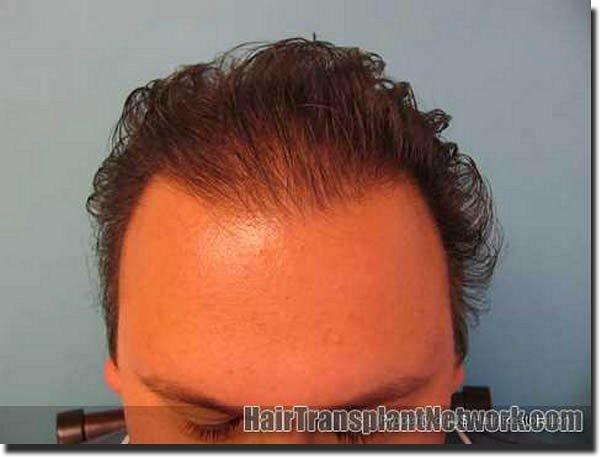 Hair restoration procedure results