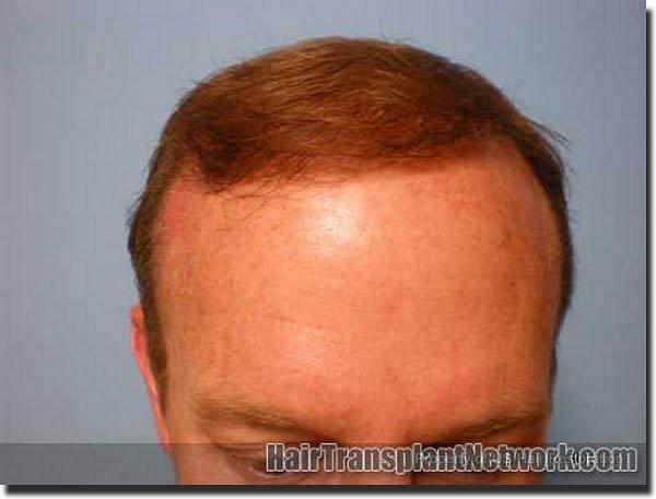 Hair restoration procedure results