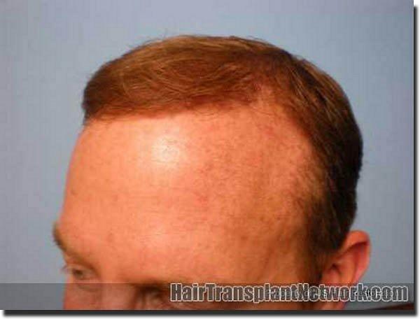 Hair restoration procedure results