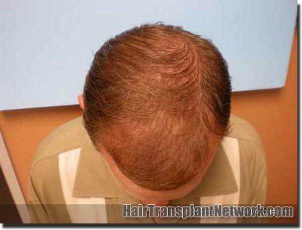 Hair restoration procedure results