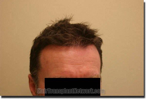 Hair restoration procedure results