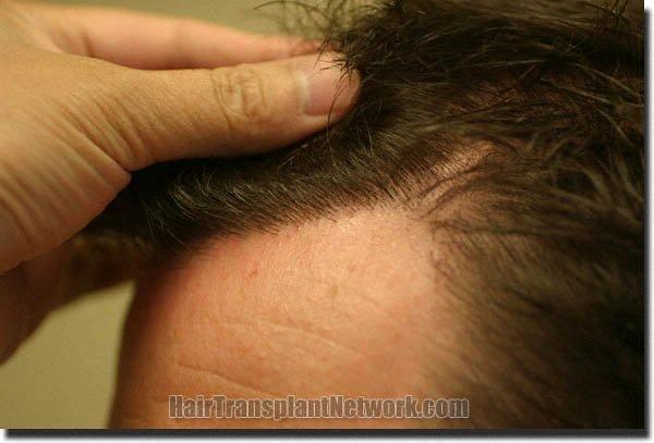 Hair restoration procedure results