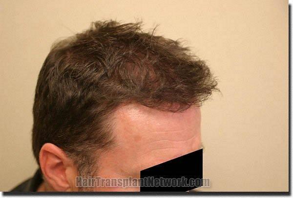 Hair restoration procedure results