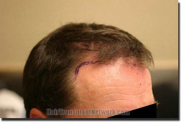 Hair restoration procedure results