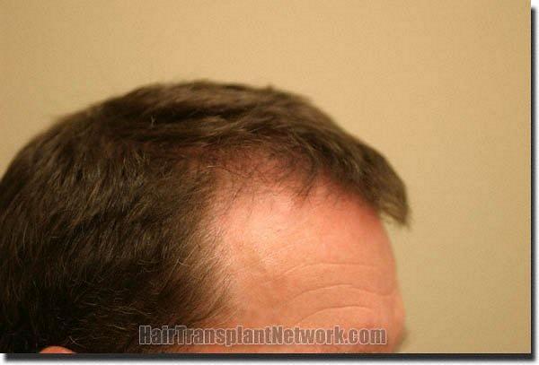 Hair restoration procedure results