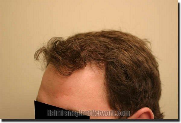 Hair restoration procedure results