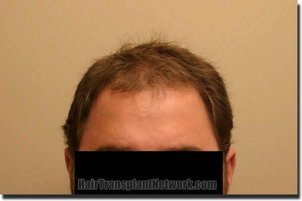 Hair restoration procedure results