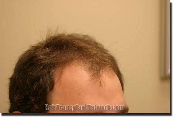 Hair restoration procedure results