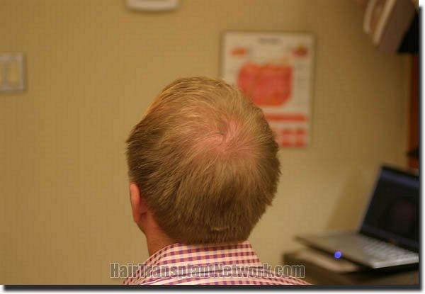 Hair restoration procedure results