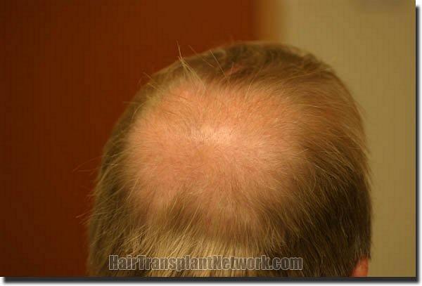 Hair restoration procedure results