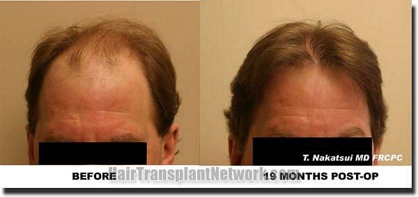 Hair restoration procedure results