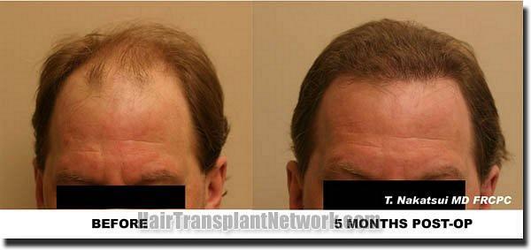 Hair restoration procedure results